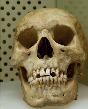 Hullerne i højre og venstre side er fremkommet af slid på grund af piberygning. Foto: Wikimedia Commons