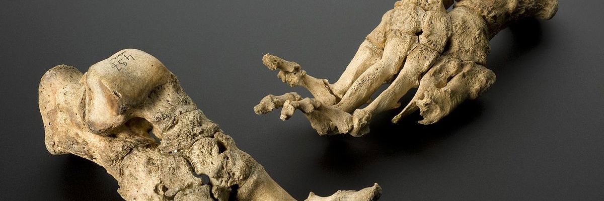 Fødder med tydelig deformation på grund af spedalskhed