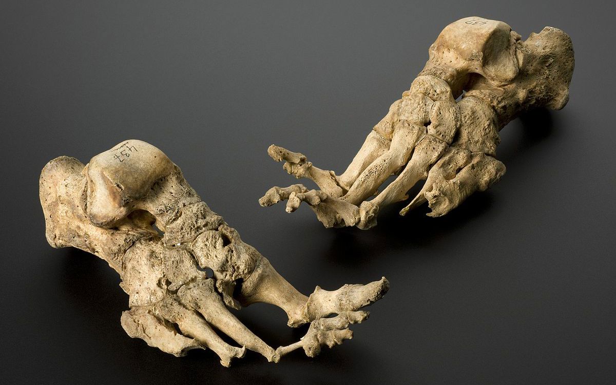 Fødder med tydelig deformation på grund af spedalskhed